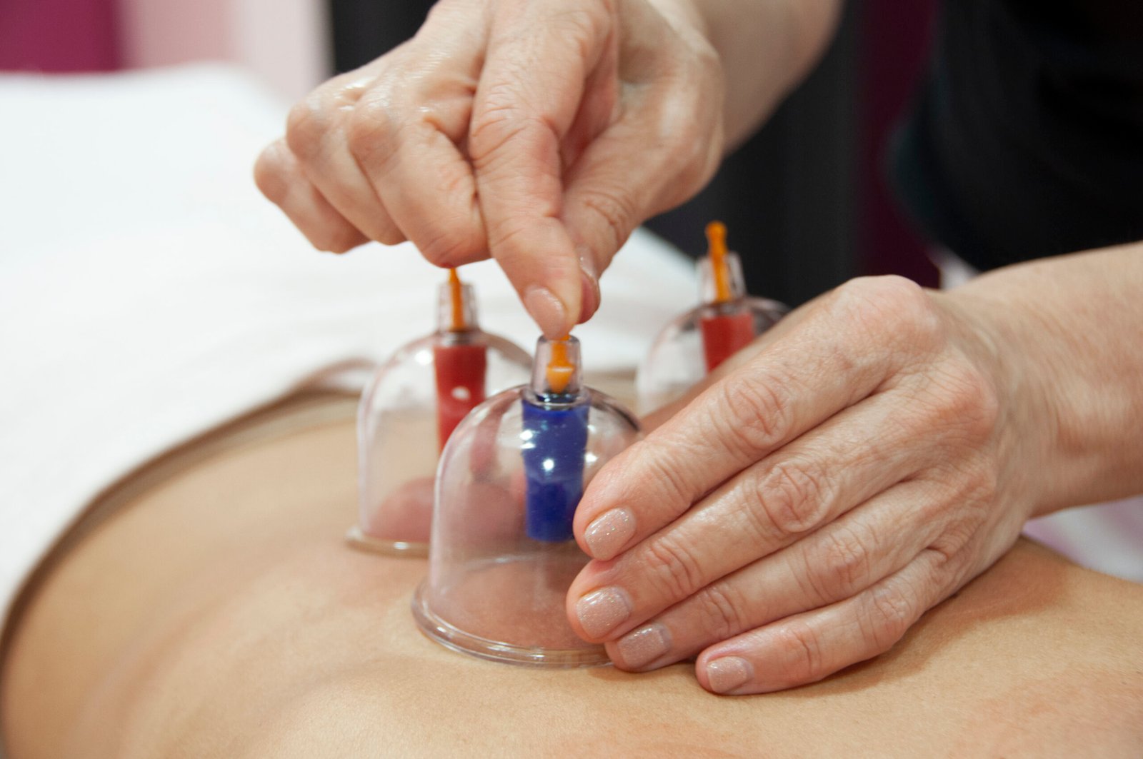 Cupping therapy για αποσυμφόρηση μυών και μείωση κυτταρίτιδας